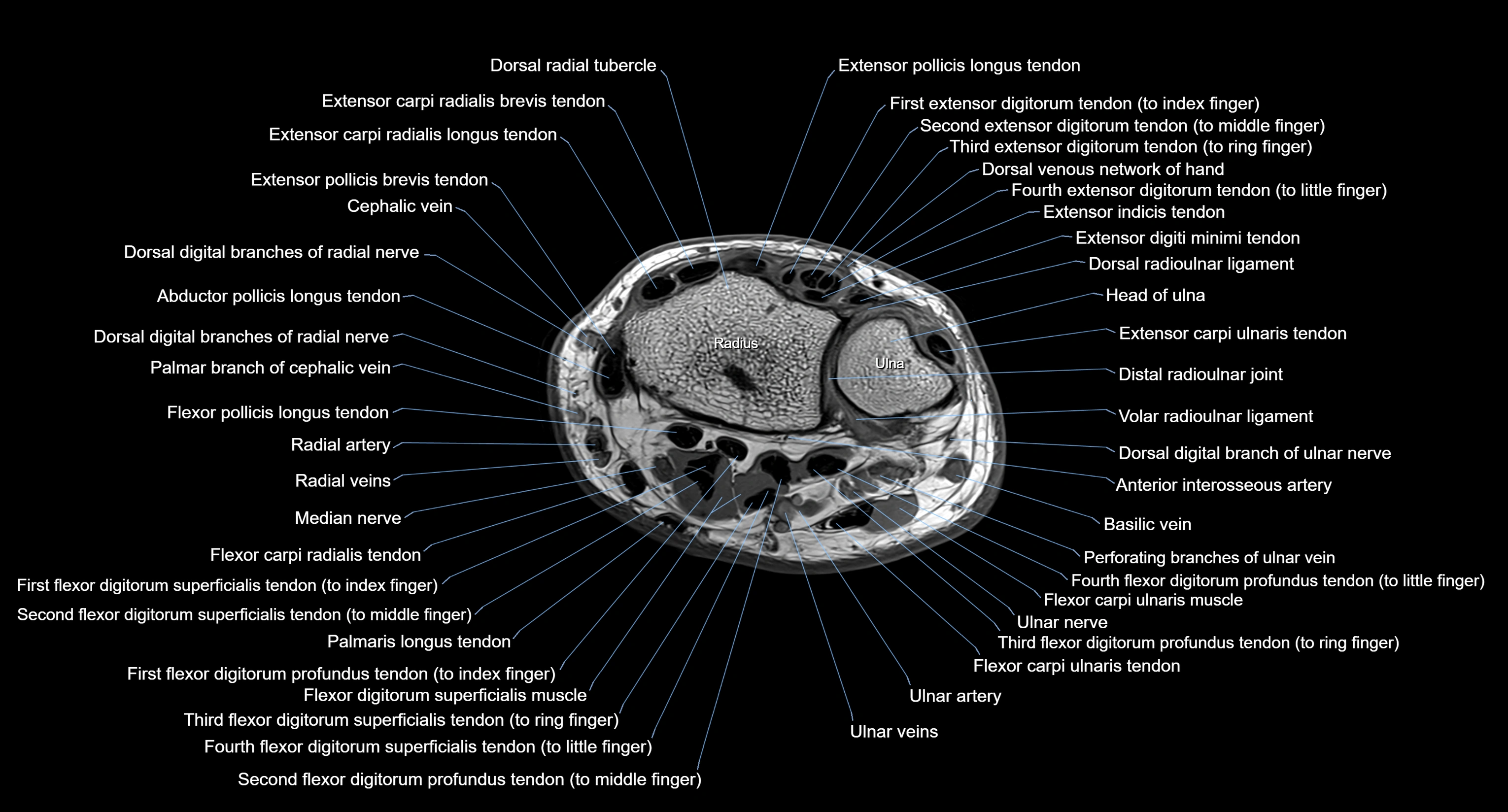 MRI wrist axial cross sectional anatomy 3T radiology  image-img-00001-00026.webp